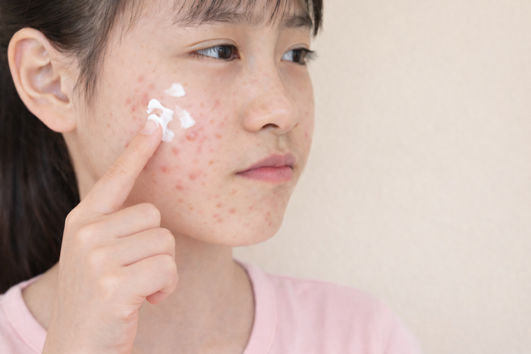 Teenage girl applying topical acne cream to red inflammatory cheek breakouts.