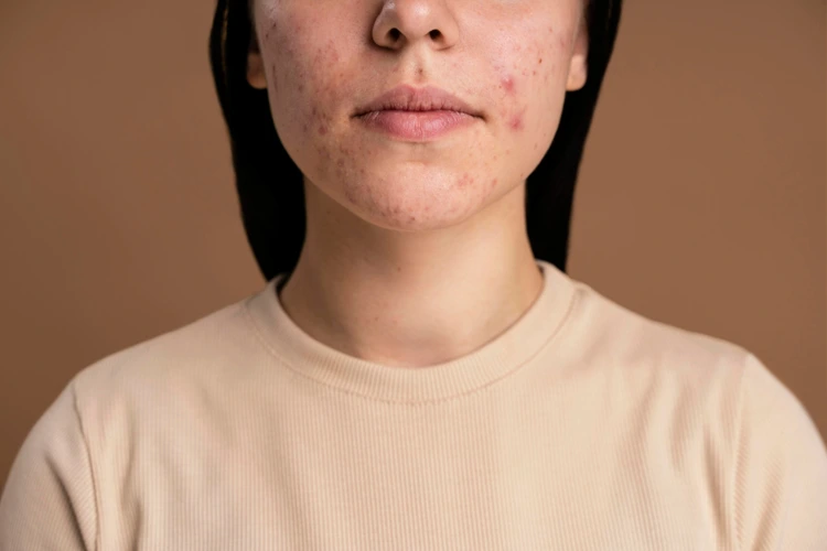 Close up view of a lady's face full of acne.