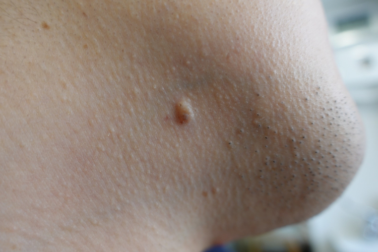 Close-up of a compound nevus with intradermal features on skin.