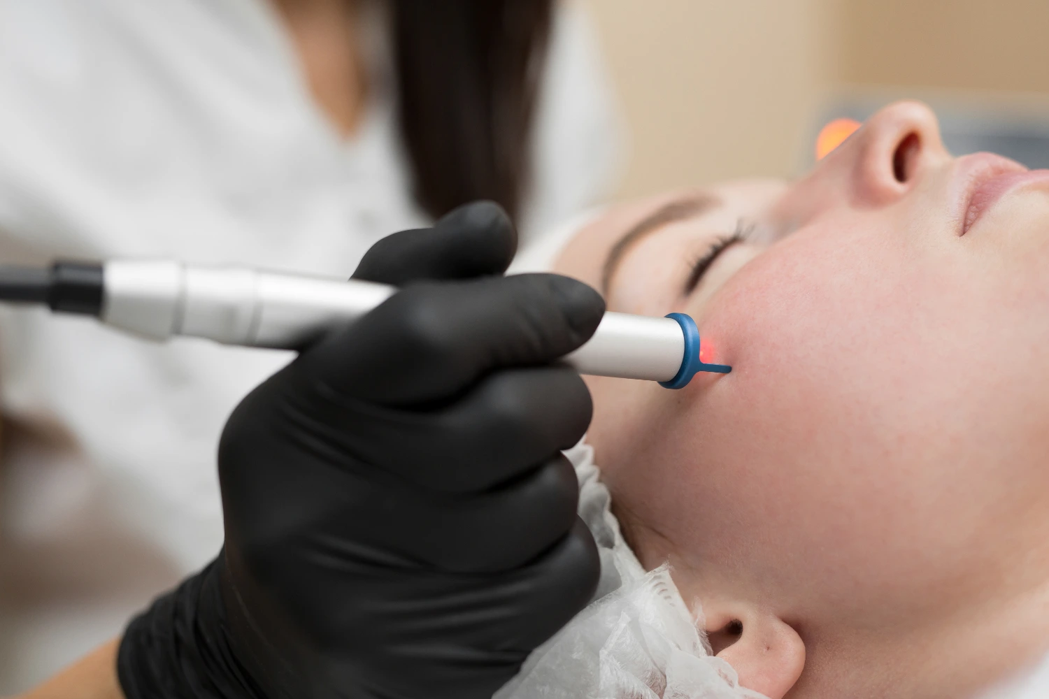 Lady undergoing Fractional CO2 Laser treatment at clinic.