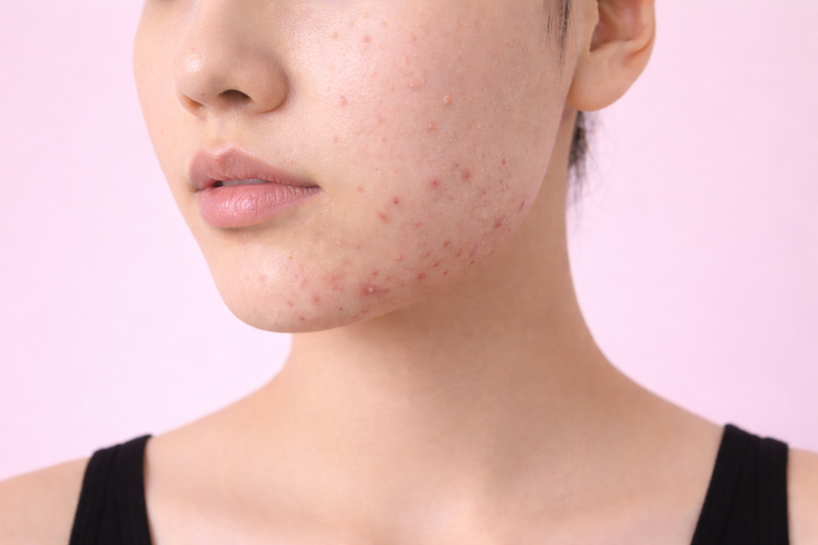 Close-up of jawline and chin acne typical of hormonal breakouts in adults.
