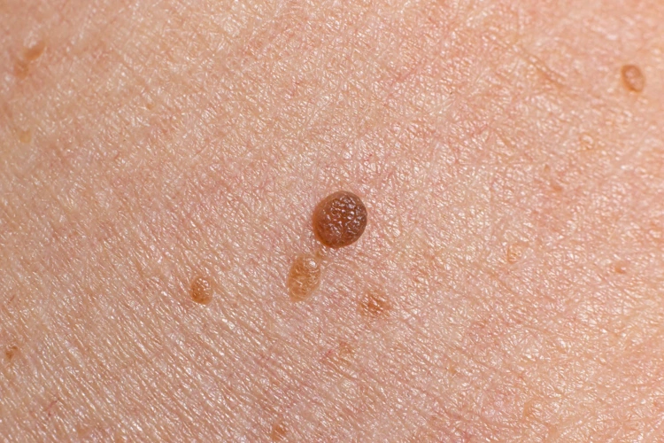 Close up view of human skin benign tumour in the form of mole.