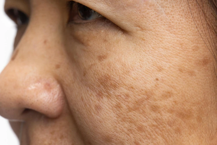 Close up view of pigmentation on left side of woman's face.