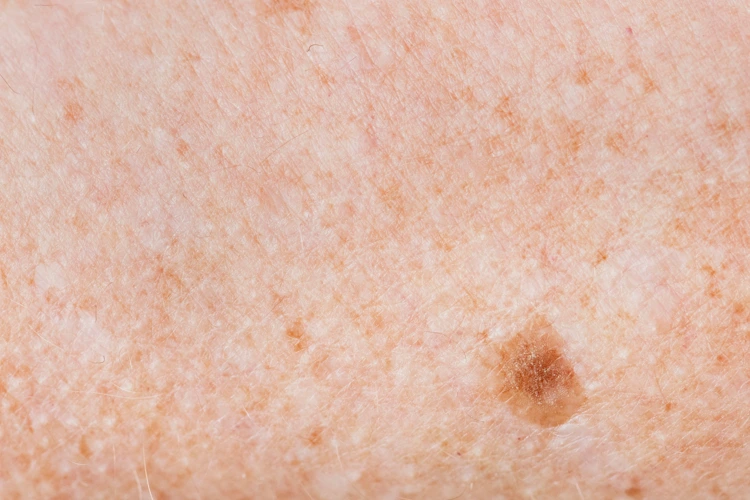Close up view of pigmentation on person's skin.