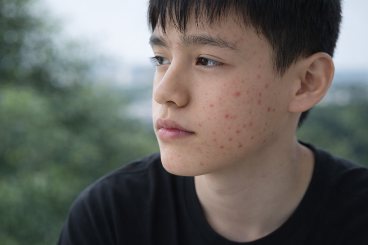 Teenage boy with visible facial acne on cheeks and chin in outdoor setting.
