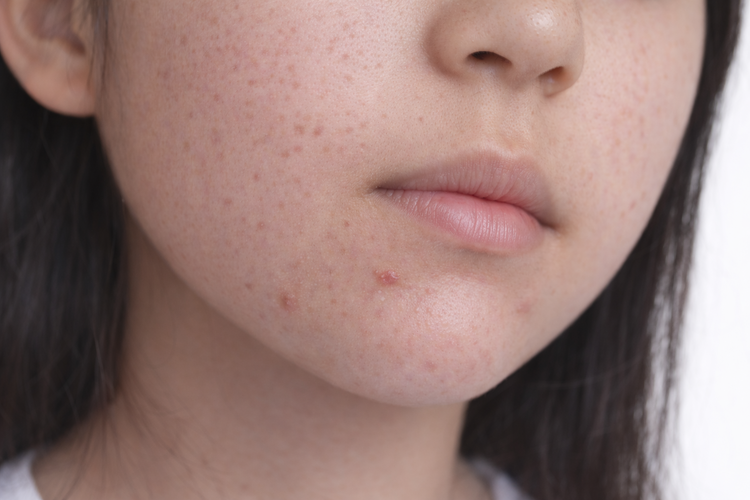 Close-up of teenage girl with mild inflammatory acne on chin and lower cheeks.