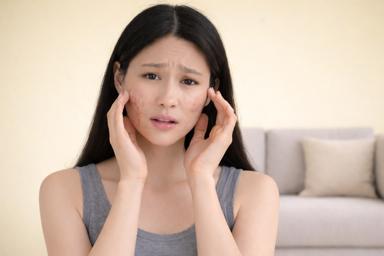 Woman touching her cheeks to illustrate stress as a trigger for hormonal acne.